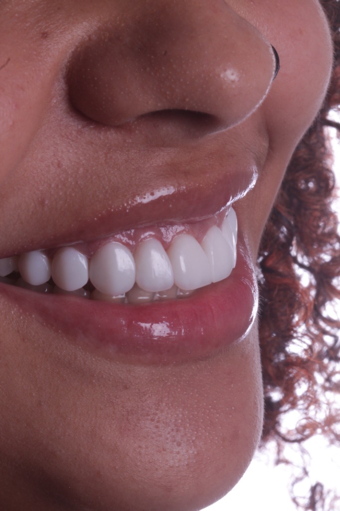 Caso de Lentes de Resina 2