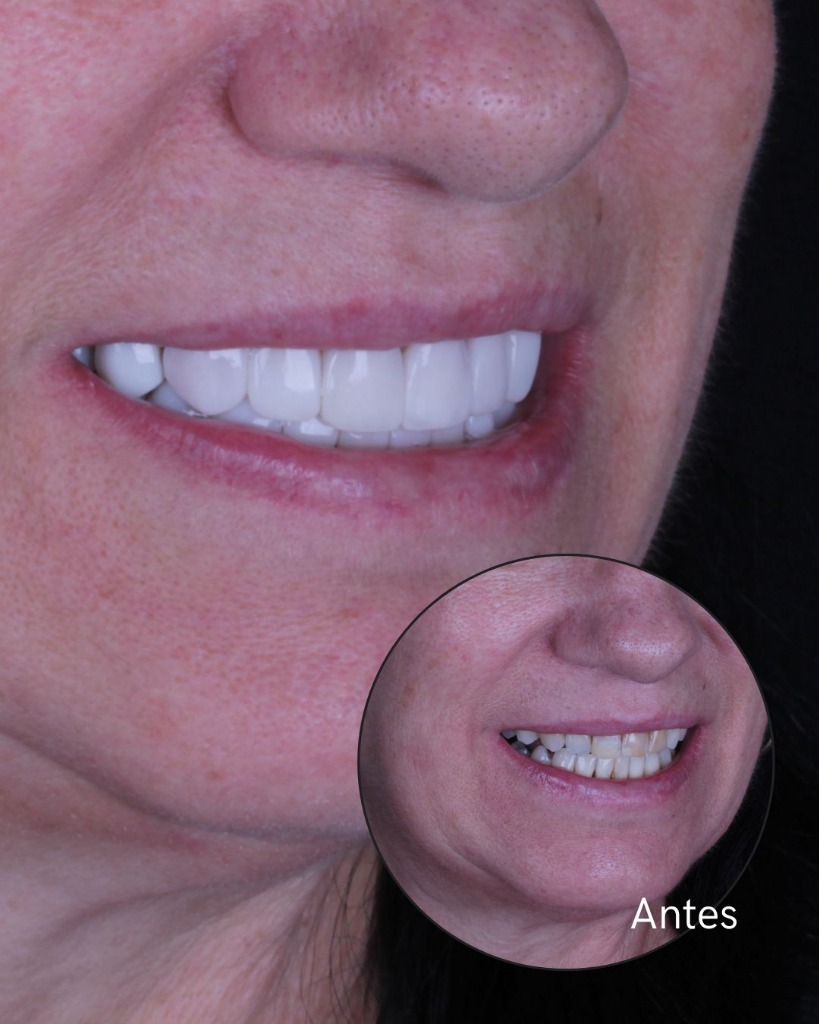 Caso de Lentes de Resina 3