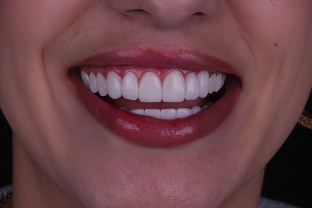 Caso de Lentes de Resina 4