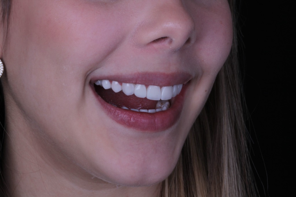 Caso de Lentes de Resina 6