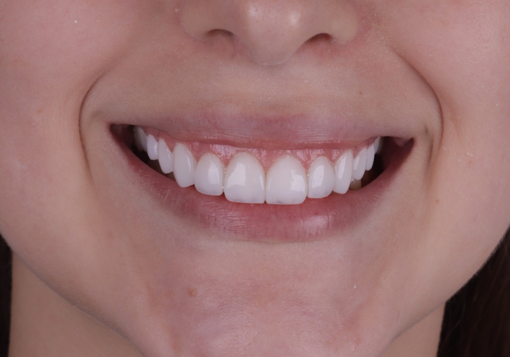 Transformação de Sorriso 7